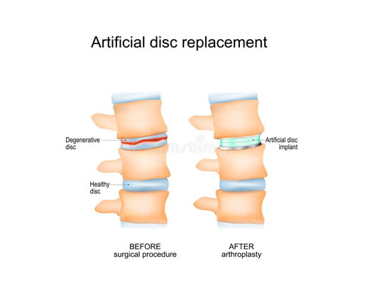 Disc Prolapse ailment-img