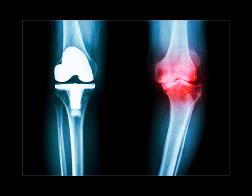 Joint Replacement treatment-img