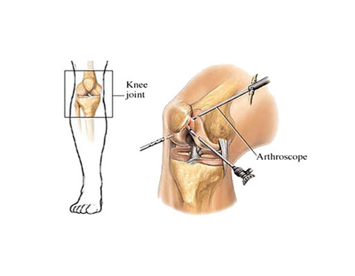 Arthroscopy treatment-img