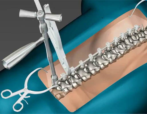 Spine Surgery treatment-img