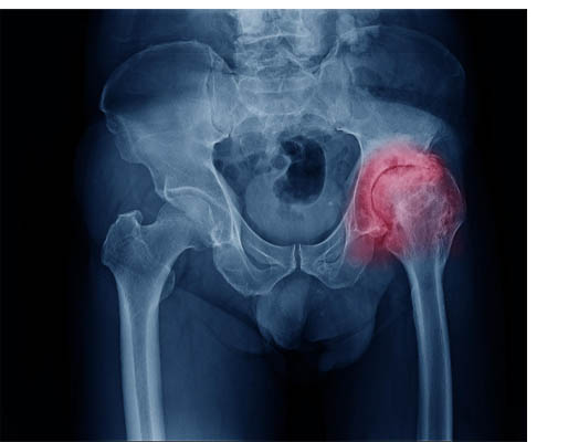 Geriatric care and Fracture treatment-img