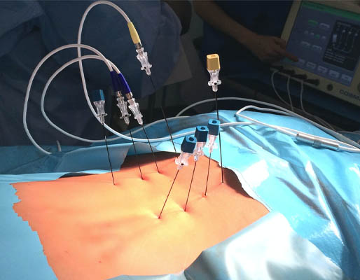 PFN Surgery treatment-img