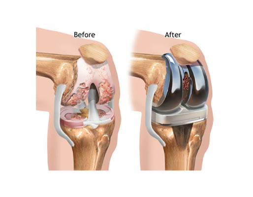 Knee Replacement treatment-img