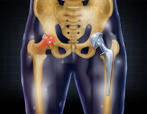 Hip Replacement treatment-img