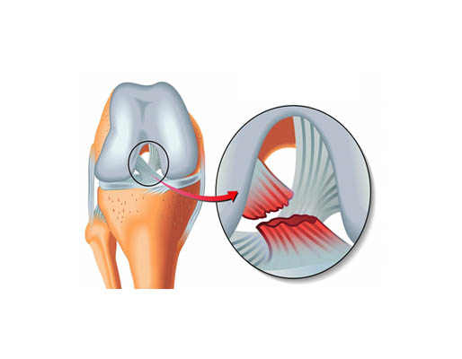 Arthroscopy Meniscus Reconstruction treatment-img